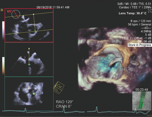 Echocardiograms May Help With Patient Selection for Transcatheter Mitral Valve Repair