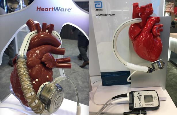CMS coverage changes effective as of Dec. 2, 2020 will open up the use of LVADs to more Medicare patients, including use of the HeartWare and HeartMate ventricular assist devices.