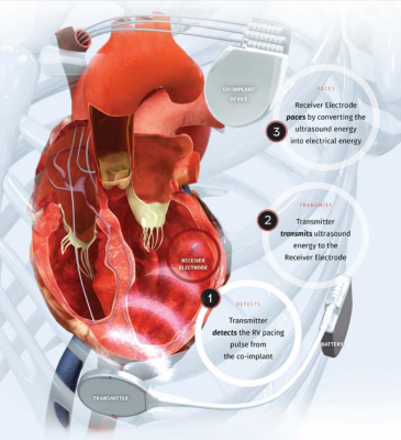 WiSE CRT System is a wireless cardiac resynchonization therapy device with no lead wires
