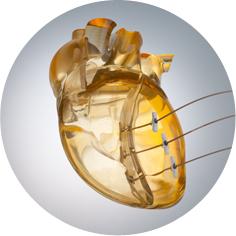 BioVentrix, Revivent TC Transcatheter Ventricular Enhancement System, LIVE procedure, first in Germany