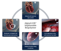 LoneStar Heart Inc.Algisyl-LVR Hydrogel Implant Heart Failure Treatment CE Mark