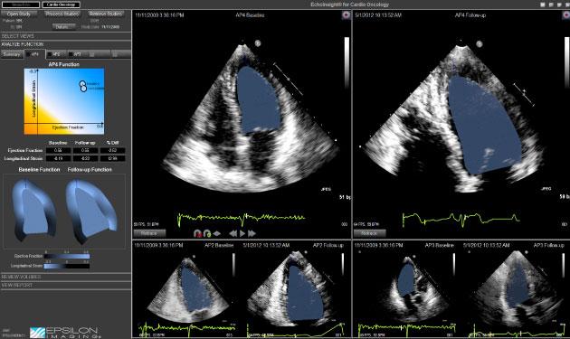 EchoInsight for Cardio Oncology