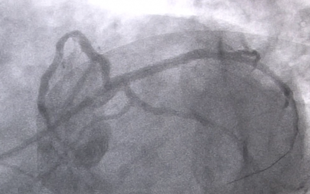 Clinical Study JAMA Percutaneous Coronary Interventions Angiography 