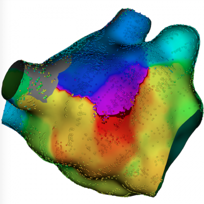The Boston Scientific Rhythmia Mapping System produces higher-density voltage maps without increasing overall procedure time.