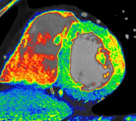 CT myocardial perfusion imaging, if validated, may enhance CT as a one-stop-shop for both anatomical and functional imaging. Shown is TeraRecon's CardiacTVA colormap CT cardiac perfusion imaging analysis showing an ischemic area (in blue) in the left ventricle.