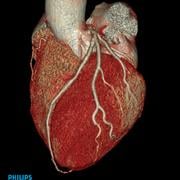 Philips iCT cardiac CTA