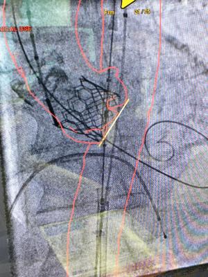 Using either a CT scan or rotational angiography acquisition in the cath lab that is fused with the live angiography, anatomical outlines can be added to aid in TAVR catheter and device delivery and to highlight anatomical landing zones and orientation for the valve. 