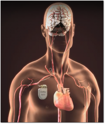 The CVRx neo, Baroreflex Neo therapy is for heart failure. It is a pacemaker like device for heart failure therapy. It was cleared by the FDA in August 2019.