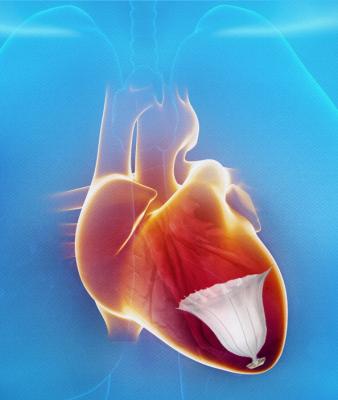 CardioKinetics PARACHUTE IV Clinical Trial Heart Failure Treatments