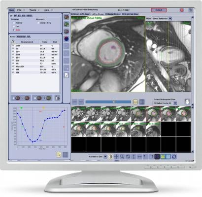 An example of the GE MRI CardiacVX analysis software for cardiac MRI.