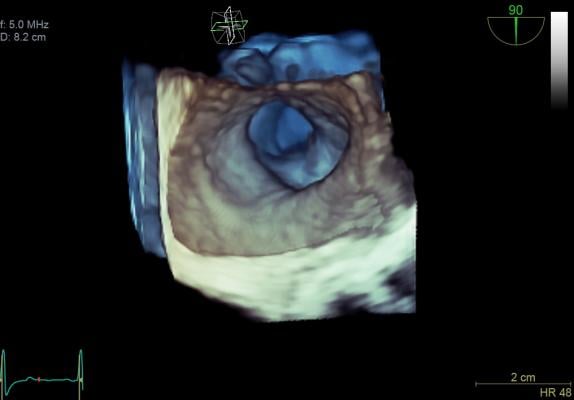 cardiovascular ultrasound, GE E95