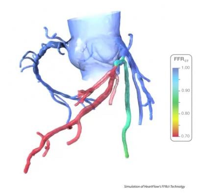 Heartflow FFR-CT report showing the hemodynalic significance of coronary lesions with a CT scan