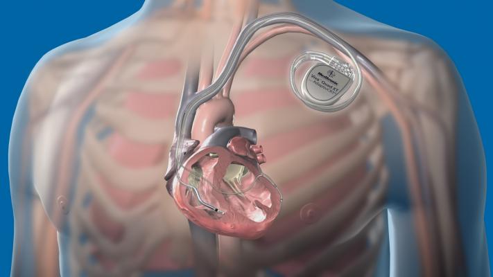 A step-by-step overview of how to perform interventional CRT (I-CRT) lead placement using the coronary sinus. This image shows the Medtronic Attain Performa quadripolar lead and VivaQuad XT CRT-D system.
