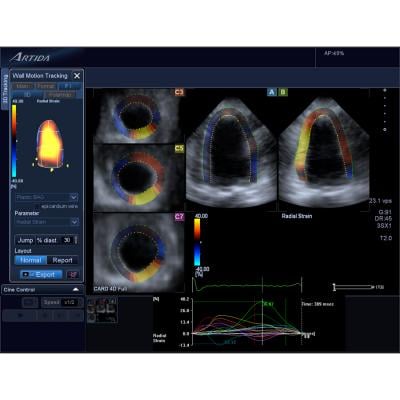 Canon's cardiac ultrasound wall motion tracking software helps quantify myocardial strain to determine cardiotoxcity caused by cancer treatments.cardio-oncology, Toshiba echo, toshiba ultrasound