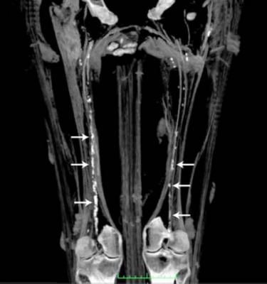 Heavy calcification of the iliofemoral arteries showing peripheral artery disease (PAD) in a 3,000 year old Egyptian mummy.