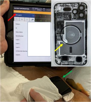 A device programmer showing the suspension of ICD therapies (orange bar, red arrow) with iPhone 12 laying over patient’s chest (green arrow) and fluoroscopy of iPhone 12 showing the circular magnet array (yellow arrow). iPhone 12 can cause ICDs to stop working