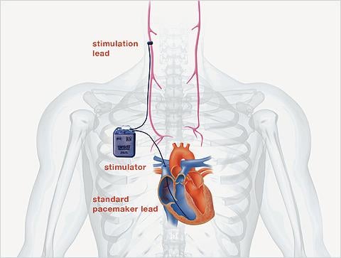 BioControl Medical Enrollment INOVATE-HF Study CardioFit System Heart Failure