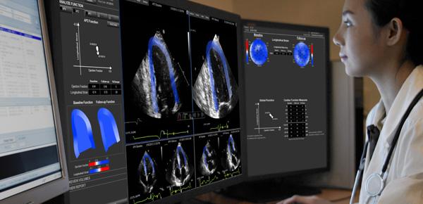 epsilon imaging echoinsight cardiac ultrasound systems mri