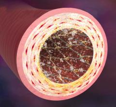 Medtronic Endeavor Stents Drug-eluting Antiplatelet Therapy Clinical Study