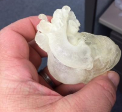 3d printing can aid procedural navigation in transcatheter tricuspid procedures