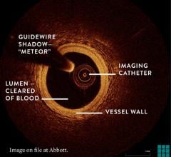 Abbott OCT intravascular imaging explained. 