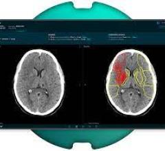 Strategic partnership increases access to advanced AI-assisted stroke care 