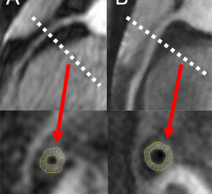 Early coronary disease and impaired heart function, with increased coronary vessel wall thickness, in asymptomatic, middle-aged individuals living with HIV has been reported in a new study published today in Radiology: Cardiothoracic Imaging, a journal of the Radiological Society of North America (RSNA).