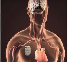 FDA Approves Barostim Neo System for Advanced Heart Failure Patients. Similar to a pacemaker, the Barostim Neo System uses a pulse generator implanted below the collar bone with a lead that attaches to the carotid artery in the neck. It delivers electrical impulses to baroreceptors in the neck, which sense how blood is flowing through the carotid arteries and relays information to the brain. The brain, in turn, sends signals to the heart and blood vessels that relax the blood vessels.