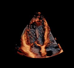cardiac ultrasound echocardiography image from a GE E95 system at American society of echo to evaluate athlete's hearts and cardiac function 