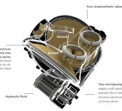 The Carmat system, an experimental artificial heart includes an autoregulation control mechanism, or Auto-Mode, that can adjust to the changing needs of patients treated for end-stage heart failure. Outcomes in the first series of patients managed with the new heart replacement pump in Auto-Mode are presented in the journal of the American Society for Artificial Internal Organs (ASAIO). 