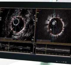 The Conavi Novasight hybrid intravascular imaging system that combines IVUS and OCT.