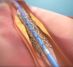 Late-breaking clinical data presented at EuroPCR 2023 in Paris demonstrated Elixir Medical’s DynamX Bioadaptor restores vessel motion and function with better effectiveness at 12 months compared to a leading drug-eluting stent (DES).