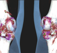 Trial for Gout Drug Meets Primary Endpoint, Raises Safety Concerns, image shows a CT scan showing gout in the knees.