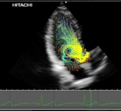 Hitachi, Vector Flow Mapping, TedMed 2016, Partho Sengupta, holographic evaluation of cardiac valves