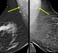 A, Normal axillary lymph nodes measuring < 1.5 cm in 63-year-old woman with BM = 43.2. B, Fat-enlarged axillary node with large fatty hilum measuring 4.2 cm in 52-year-old woman with BMI = 45.8.
