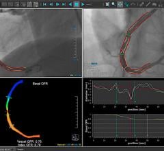 The Medis Quantitative Flow Ratio (QFR) is a novel, non-invasive, angiography-based physiologic FFR-like assessment of the presence and extent of coronary artery disease. 