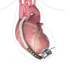 FDA Class I Recall Issued for Medtronic HeartWare HVAD Pump
