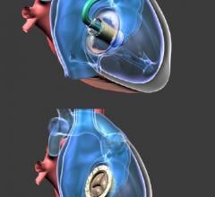Gate Bioprosthesis Used in Canada's First Transcatheter Valve Replacement for Tricuspid Regurgitation