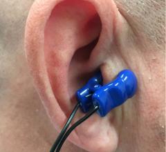 The Parasym Salustim device ear clip stimulates the vagus nerve, which was found to reduced AF burden compared with a sham procedure in the TREAT AF trial. 