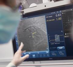 The Philips Healthcare SyncVision system co-registers iFR hemodynamic blood flow measurements to live angiograms to enable easier assessment of which lesions in a vessel need to be stented and which can be left alone and treated medically.