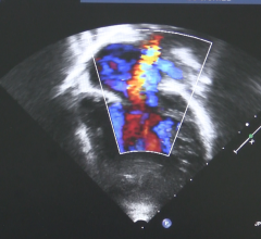 heart valve regurgitation seen on an echocardiogram, cardiac ultrasound, from ASE study
