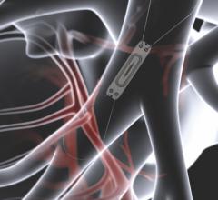 Abbott Initiates GUIDE-HF Trial for Improved Outcomes With CardioMEMS Monitor