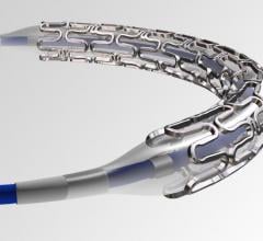 The Indian-made SMT SuperFlex stent. SMT has been developing stents and other interventional products designed to be a more affordable, home-grown option for the growing Indian market.