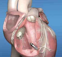 New pacemakers offer 40% more battery life, extend Medtronic legacy of pacing leadership 
