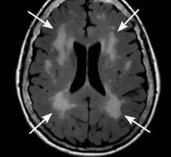 An example of white matter hyperintensities (WMHs) on a FLAIR MRI scan in an older adult. FLAIR MRI is a technique that is particularly good at detecting fluid in the brain