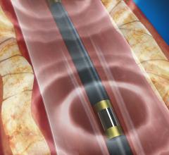 Lithotripsy Safe and Effective in Calcified Stenotic Peripheral Arteries