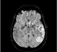 Brain-scan guided emergency stroke treatment can save more lives