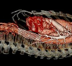 Thoracic abdominal aortic stent graft used to treat  Type B aortic dissections (TBAD). The STS and SVS released new reporting standards for TBAD.