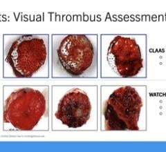 Visual Thrombus Assessment as presented by Dr. William Gray at the Cardiovascular Research Technologies (CRT) 2024 conference.