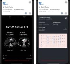 Screen shots of Viz PE with RV/LV ratio data (left), along with the company’s ECG Viewer (right). Both are part of the comprehensive Viz Cardio Suite designed to speed and improve patient access to innovative cardiovascular treatments. Source: Viz.ai.